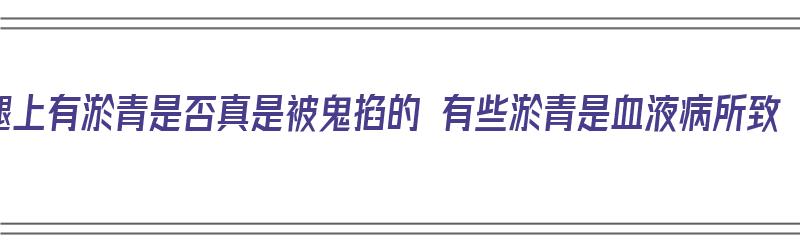 腿上有淤青是否真是被鬼掐的 有些淤青是血液病所致（腿上有淤青是被鬼摸了吗）